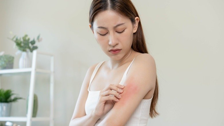 femme atteinte d'eczéma touchant la peau