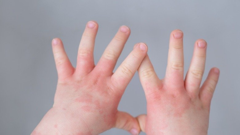 eczéma du bébé sur les mains