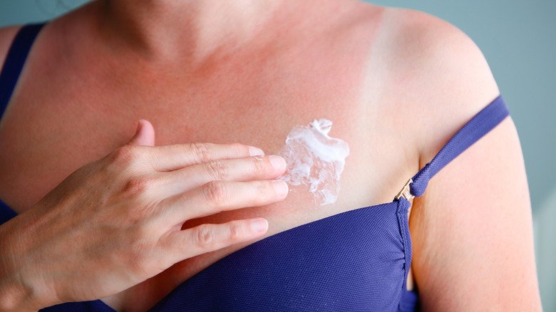 Appliquer une crème hydratante sur un coup de soleil