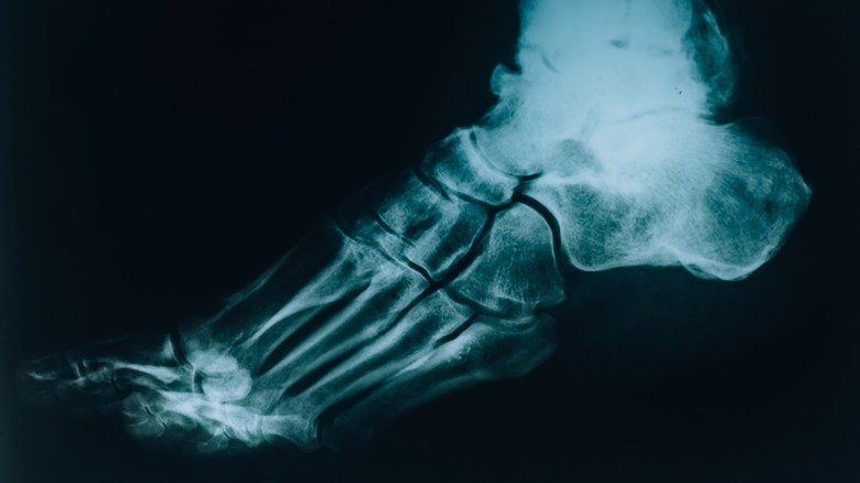 Radiographie d'un pied cassé 