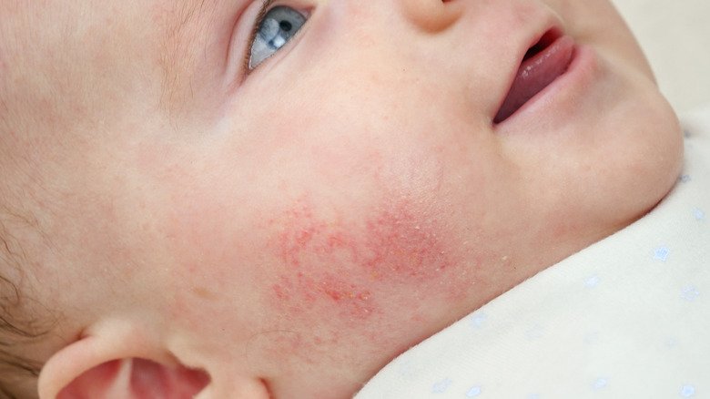 Eczéma sur le visage du bébé