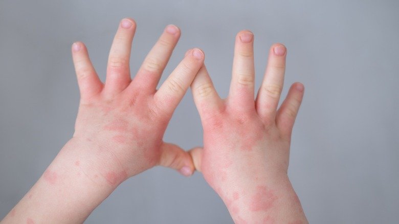 Eczéma sur les mains de bébé