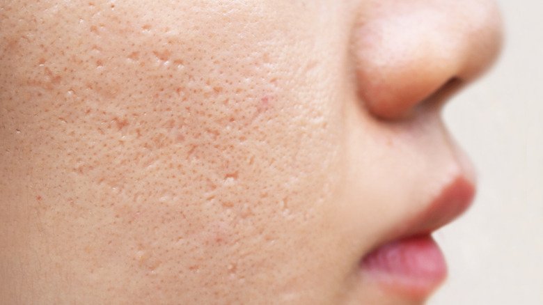 femme avec des cicatrices d'acné en forme de pic à glace