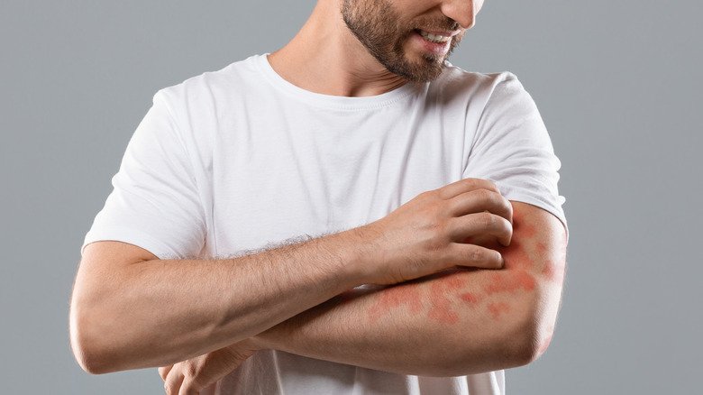 homme barbu avec de l'eczéma sur le bras