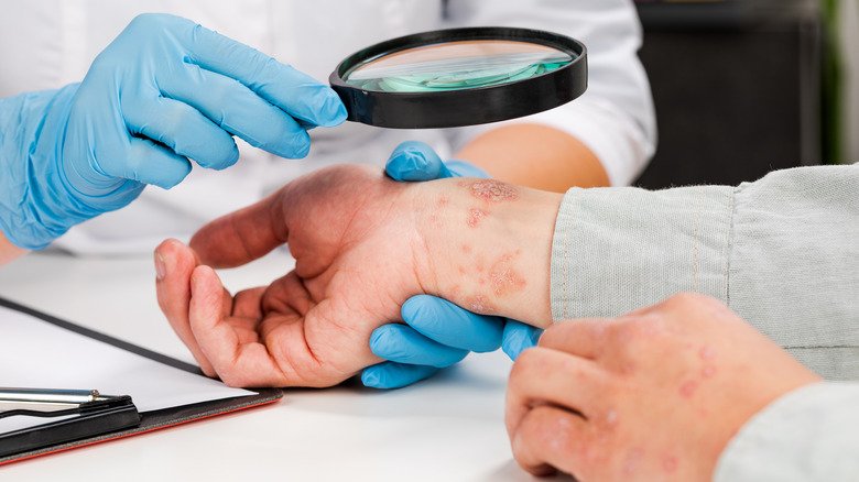 un dermatologue examine l'éruption cutanée