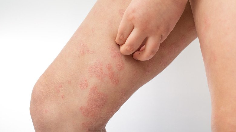 Dermatite atopique sur la jambe d'un enfant