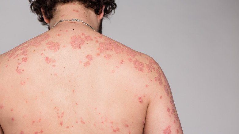 Éruption cutanée due au psoriasis sur le dos d'une personne