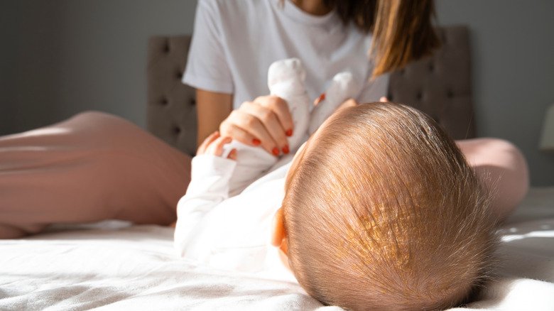 Bébé avec croûtes de lait