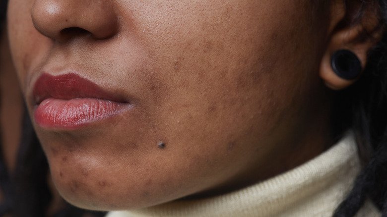 Menton d'une femme noire avec de l'acné