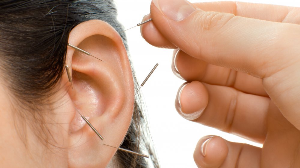 Une personne reçoit de l'acupuncture dans l'oreille