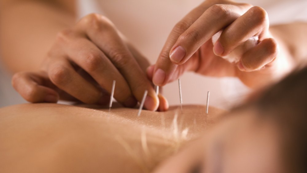 Une femme reçoit de l'acupuncture sur le dos