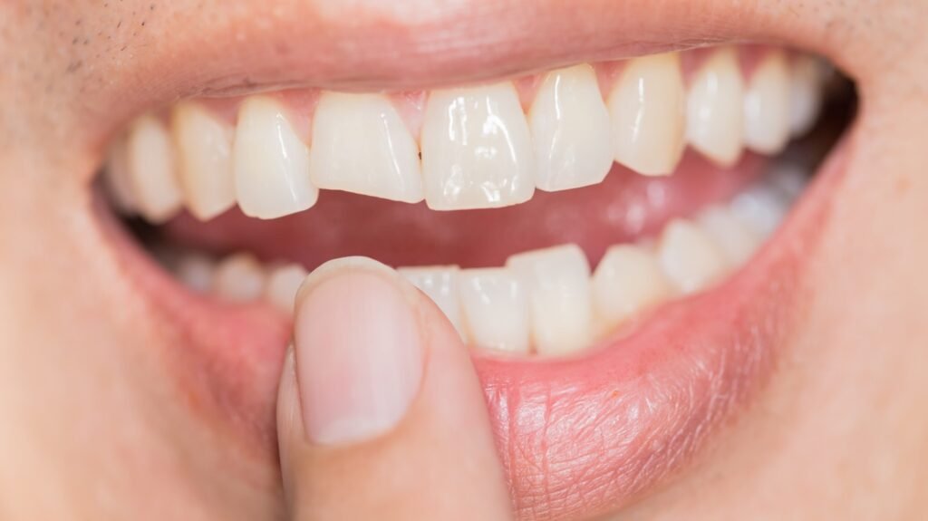 De plus en plus de personnes ont des dents fissurées en ce moment : voici pourquoi